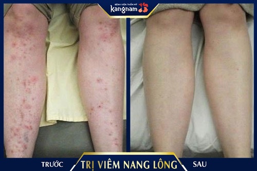 viêm chân lông vùng kín nam giới