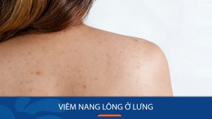 Viêm nang lông ở lưng: Dứt điểm NHANH CHÓNG chỉ trong 7 ngày