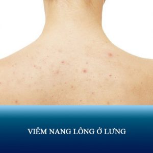 Nguyên nhân – Triệu chứng – Cách điều trị viêm nang lông ở lưng