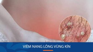 Viêm nang lông vùng kín: Giải mã nguyên nhân và cách điều trị DỨT ĐIỂM