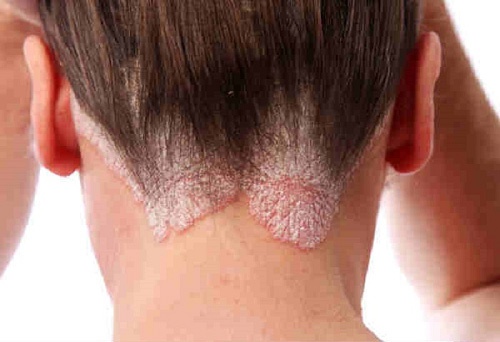 Bệnh viêm chân tóc: Triệu chứng & Cách chữa trị dứt điểm