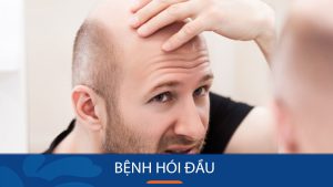 Bệnh Hói Đầu: 7 Nguyên nhân, 3 Dấu hiệu, 6 Cách điều trị