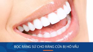 Bọc răng sứ cho răng cửa bị hô vẩu – Giải pháp cho nụ cười tự tin
