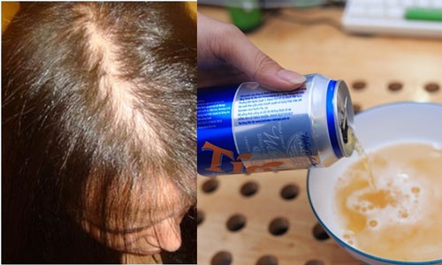 cách trị rụng tóc bằng bia
