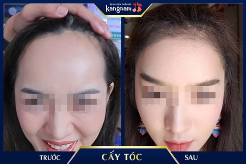 hói trán có chữa được không