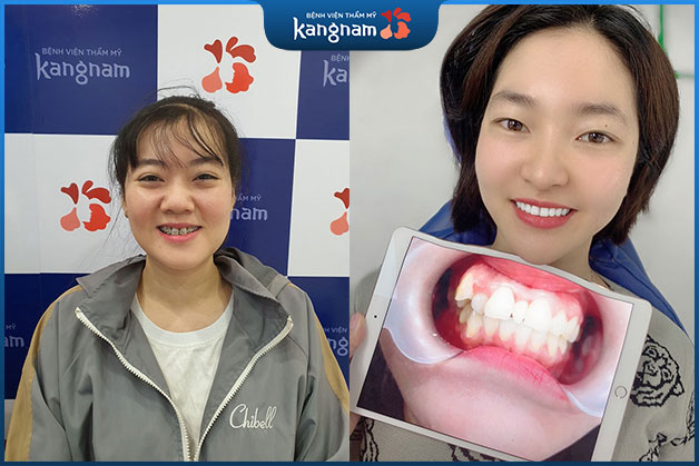 Niềng răng cũng là phương pháp giúp "giải cứu" hàm răng khấp khểnh bẩm sinh của chị Hoa (Thanh Hóa)