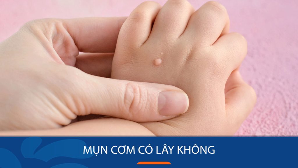 Mụn cơm có lây không?Bí quyết phòng ngừa lây lan mụn cơm đơn giản tại nhà