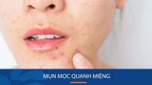 Bí quyết đánh bay mụn mọc quanh miệng hiệu quả tại nhà