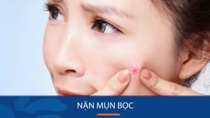 Mụn bọc – Nặn hay không nặn? 10 bí quyết “vàng” để xử lý an toàn”.