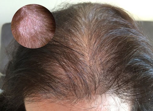 Rụng tóc ở tuổi dậy thì: Nguyên nhân & cách chữa trị dứt điểm