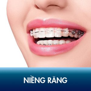 Niềng răng mang lại lợi ích gì? Phương pháp niềng răng mới