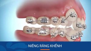 Niềng răng khểnh Kangnam – Hết răng lệch lạc, xiên vẹo