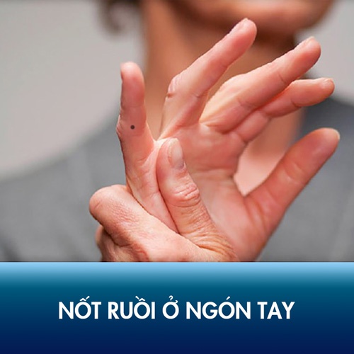 Nốt ruồi trong lòng bàn tay trái phải có ý nghĩa gì?