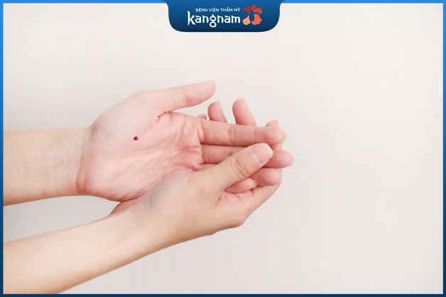 Nốt ruồi trên mu bàn tay nam và nữ có ý nghĩa gì đặc biệt