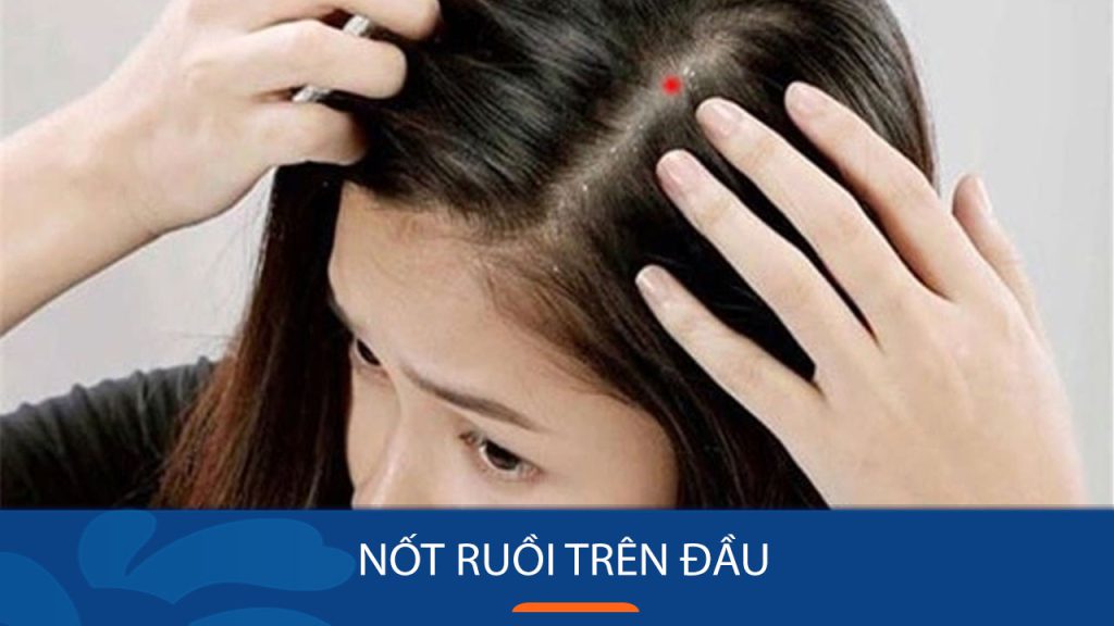 6 Vị trí nốt ruồi trên đầu tiết lộ điều gì về tính cách và vận mệnh của bạn?