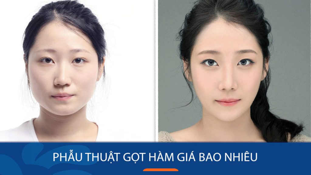 Phẫu thuật gọt hàm: Bí quyết sở hữu khuôn mặt V-line hoàn hảo