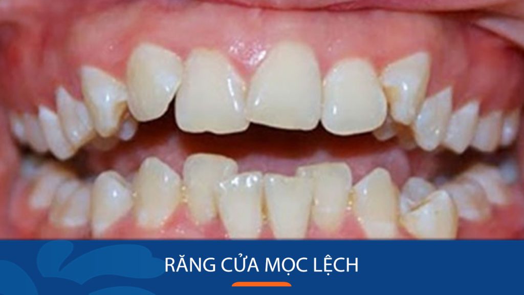 Nguyên nhân răng cửa mọc lệch và cách điều trị hiệu quả 90%