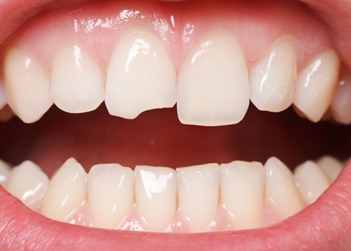 răng sứ ceramill là gì