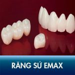 Răng sứ Emax – Răng bọc sứ tự nhiên như thật, bền đẹp nhiều năm