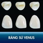 Răng sứ Venus có tốt không? Ưu điểm – nhược điểm của mão Venus Đức
