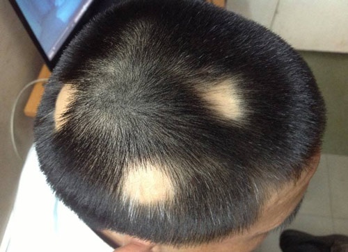 Rụng tóc từng mảng: Nguyên nhân, dấu hiệu, chẩn đoán và cách trị