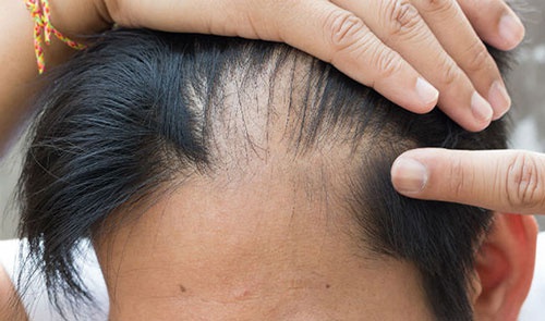 Top 5 dầu gội trị rụng tóc tốt nhất chuyên gia khuyên dùng