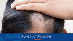 Rụng tóc từng mảng: Nguyên nhân & Cách điều trị bệnh