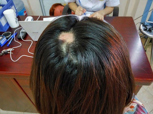Rụng tóc từng mảng là bệnh gì Nguyên nhân dấu hiệu cách chữa trị