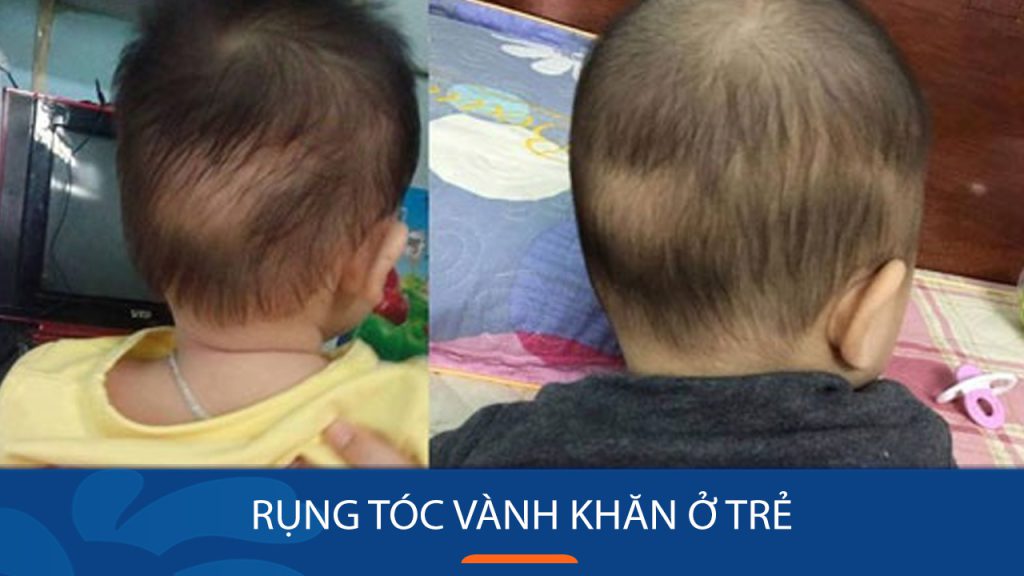 Rụng tóc vành khăn ở trẻ: Nguyên nhân và cách chữa trị