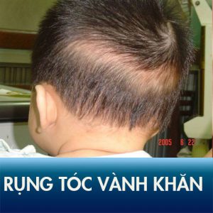 Rụng tóc vành khăn ở trẻ: Nguyên nhân và cách chữa trị