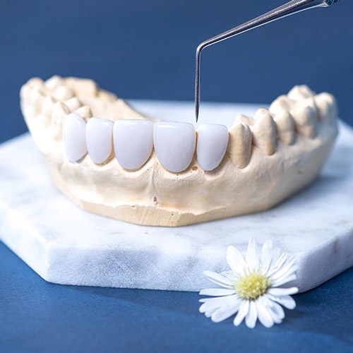 so sánh răng sứ cercon và zirconia