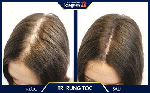 rụng tóc mảng tròn 