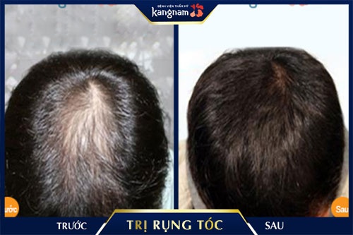 Rụng tóc nhiều ở nam giới Nguyên nhân  12 cách điều trị  Rungtocvn