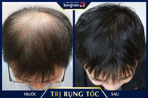 12 nguyên nhân gây rụng tóc nhiều và cách khắc phục  Rungtocvn