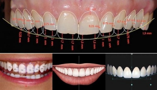 răng sứ dùng được bao lâu 