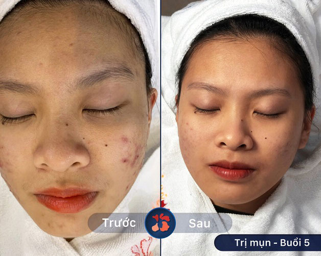 Kết quả trước và sau khi khách hàng điều trị mụn tại Kangnam