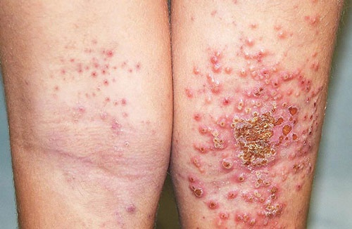 Hình ảnh chàm bội nhiễm do virus Herpes simplex gây nên mang tới những hư tổn nặng nề trên bề mặt da