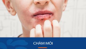 Bệnh chàm môi là gì? – Nguyên nhân, cách điểu trị tận gốc