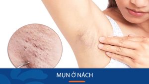 Cách trị mụn nách hiệu quả DỨT ĐIỂM trong 7 ngày