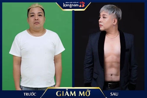 Nam ca sĩ Philippine giảm 32cm vòng bụng sau giảm mỡ tại Kangnam