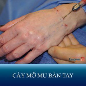 Cấy mỡ mu bàn tay – Giải pháp hàng đầu khắc phục