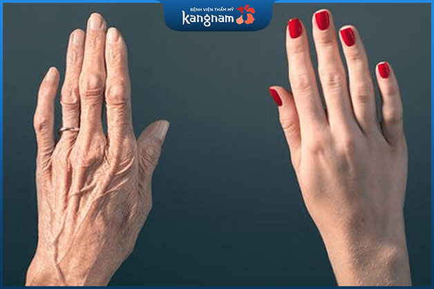 Cấy mỡ bàn tay giúp loại bỏ tình trạng tay gầy gò, gân guốc
