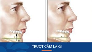 Phẫu thuật trượt cằm v-line: hướng dẫn chi tiết quy trình, kết quả, và câu hỏi thường gặp