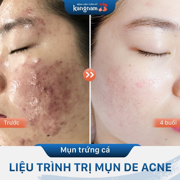 Mặt sạch mụn mịn màng sau 4 buổi thực hiện