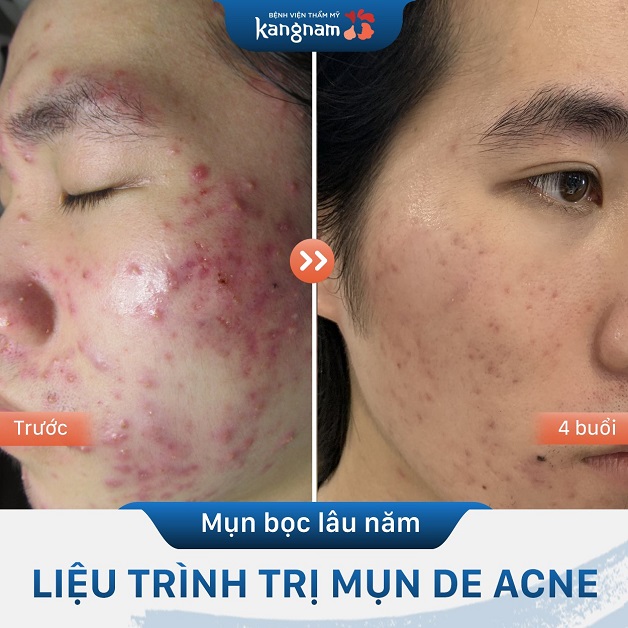 Điều trị mụn bọc lâu năm bằng công nghệ De Acne