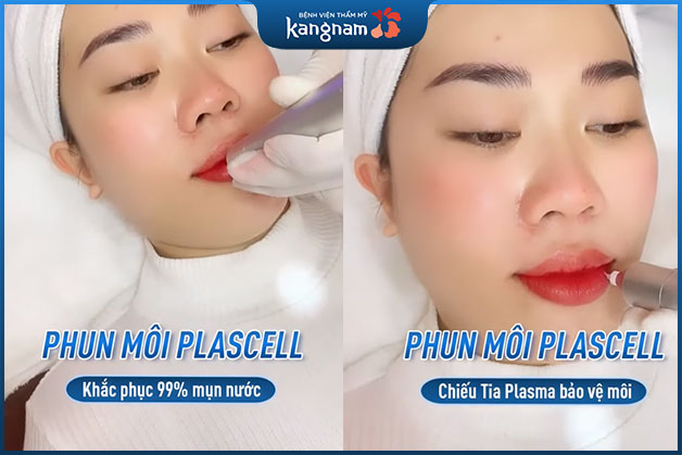 Kangnam chiếm hữu technology phun môi Plascell tiên tiến