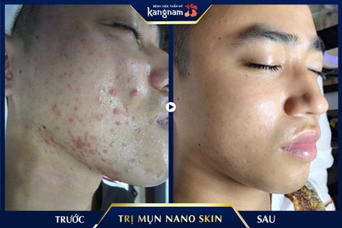 Gương mặt trở nên mịn màng và đẹp hơn sau khi khách hàng điều trị mụn tại Kangnam