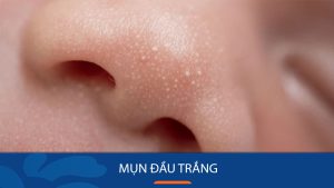 Bí quyết trị mụn đầu trắng hiệu quả chỉ trong 7 ngày