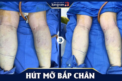 ăn trứng luộc giảm cân