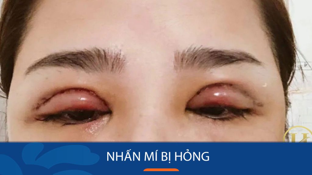 Nhấn mí bị hỏng – Nguyên nhân, biểu hiện và cách khắc phục “chuẩn chỉnh”